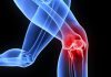 6 Things You Should Consider Knowing About Knee Replacement Surgery