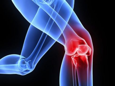 6 Things You Should Consider Knowing About Knee Replacement Surgery