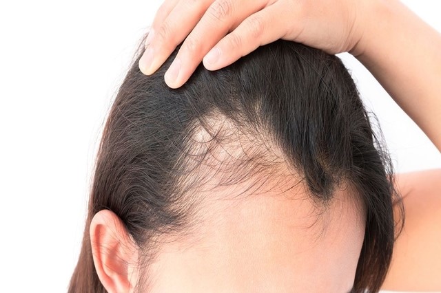 traction alopecia treatment at home